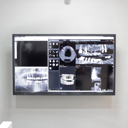 精密インプラント精密義歯（入れ歯）